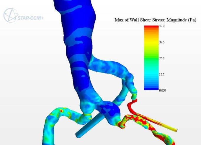 Simulation for medical devices 3 CFD model of abdominal aortic aneurysm for development of medical device