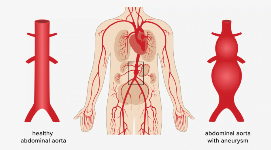 Simulation for medical devices 2 Description of the condition of abdominal aortic aneurysm