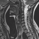 Báo Cáo Lâm Sàng ROBOSPINE: Vẹo Cột Sống S-Shape Và Thoát Vị C6-C7