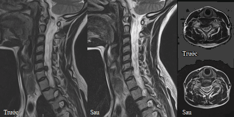 Báo Cáo Lâm Sàng ROBOSPINE: Vẹo Cột Sống S-Shape Và Thoát Vị C6-C7 13 Case 2: Thoát vị C6-C7 kèm hẹp ống sống ở bệnh nhân 43 tuổi