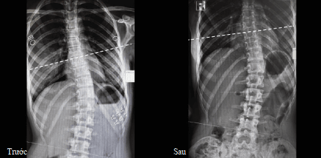 Báo Cáo Lâm Sàng ROBOSPINE: Vẹo Cột Sống S-Shape Và Thoát Vị C6-C7 2 Case 1: Nữ 19 tuổi vẹo cột sống hình chữ S độ 2